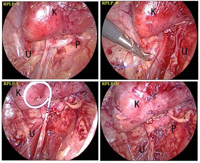 Comparative study of different surgical approaches for treatment of UPJ obstruction according to the degree/severity of hydronephrosis factor